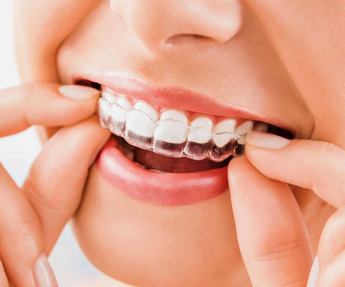 ORTODONZIA INVISIBILE