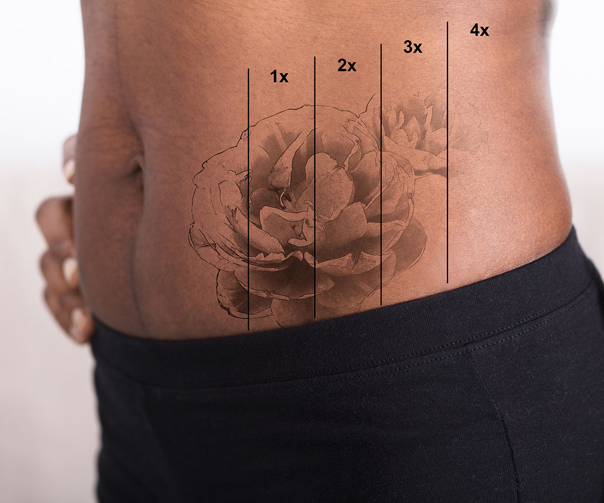 Rimozione tatuaggi