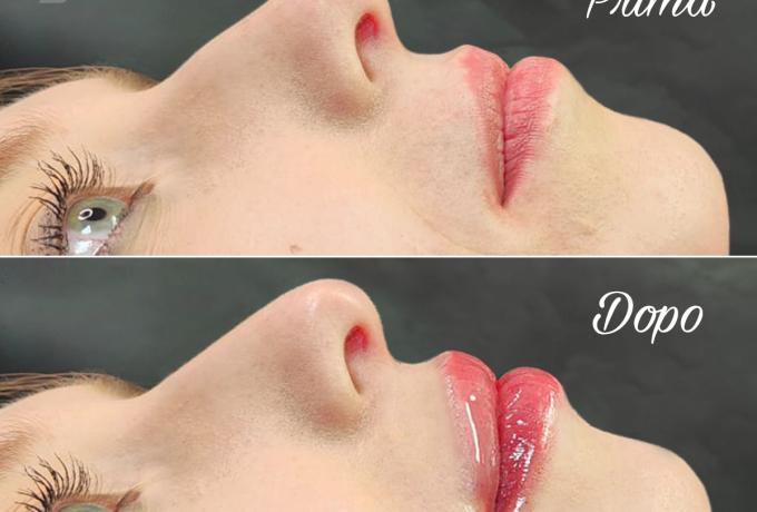 FILLER LABBRA E VISO - Centro Biolab Cutrofiano