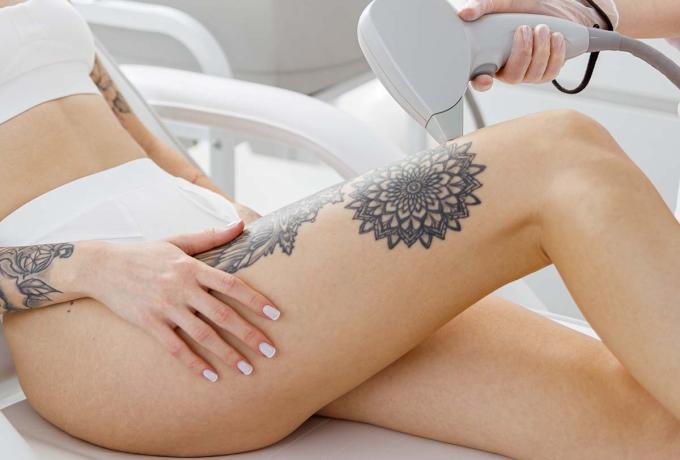 RIMOZIONE TATUAGGI - Centro Biolab Cutrofiano